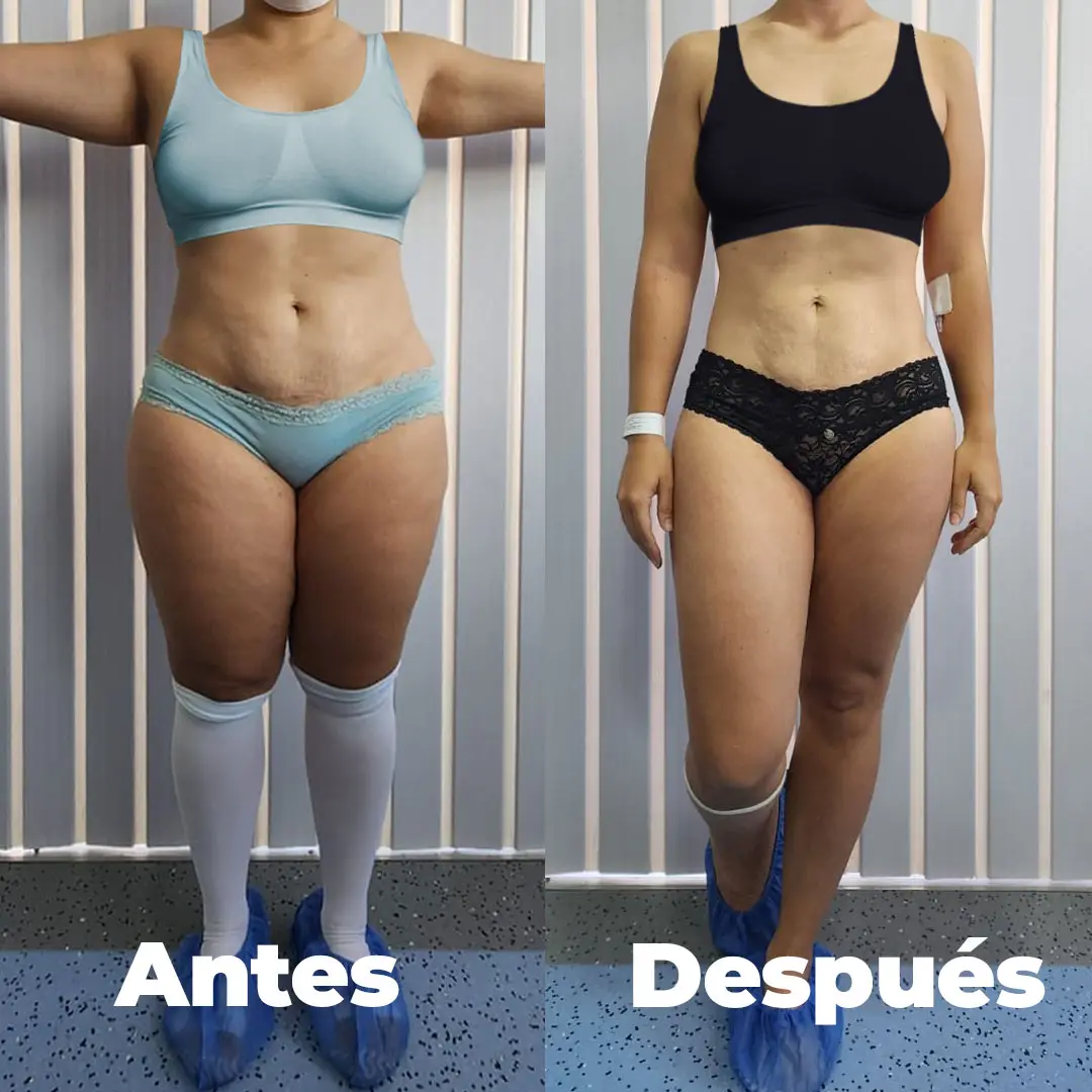Antes y después — vista frontal