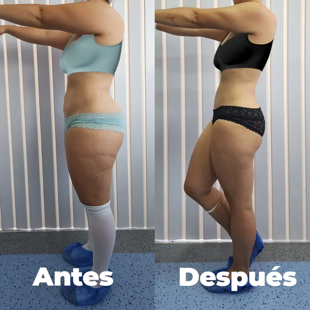 Antes y después — vista de perfil