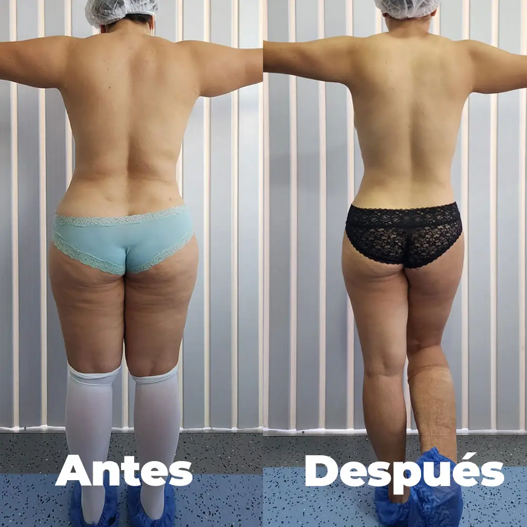 Antes y después — vista posterior